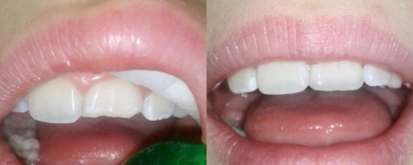Клиника «Denta Guard»: реставрация/восстановление зубов