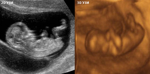 Беременность 12 недель мальчик. 3д УЗИ В 12 недель беременности пол ребенка. УЗИ девочки и мальчика в 20 недель беременности. УЗИ 12 недель беременности мальчик 3д. УЗИ В 20 недель беременности мальчик 3д.